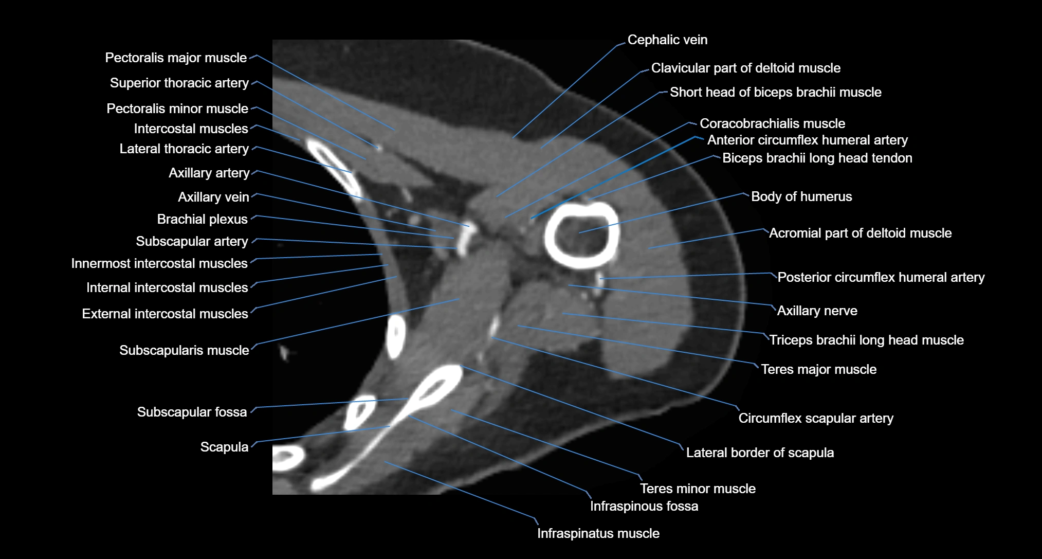 CT Shoulder axial cross sectional anatomy labelled radiology image -00048.webp